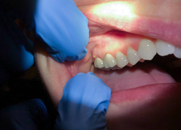 Best Root Canal Emergency Dentist  in Castle Point, MO